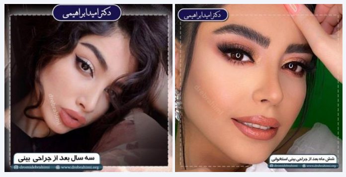 راز موفقیت در جراحی بینی استخوانی ؛ انتخاب جراح مناسب مهم‌تر از هر چیز است