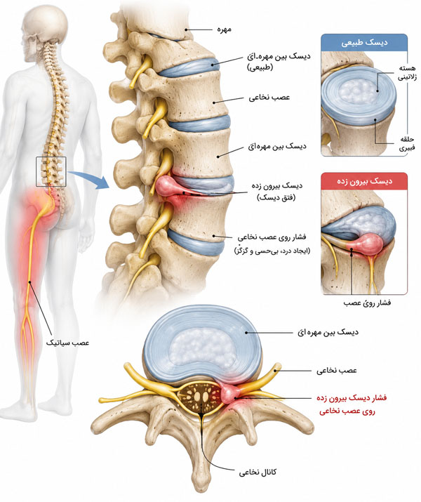 نمایش مشکلات ستون فقرات و فشار دیسک روی عصب