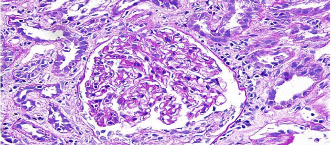 Acute-Interstitial-Nephritis.jpg
