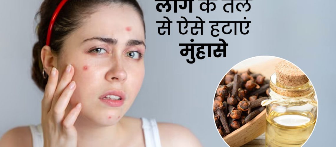 Clove-Oil-To-Remove-Acne-Pimples-In-Hindi-.jpg