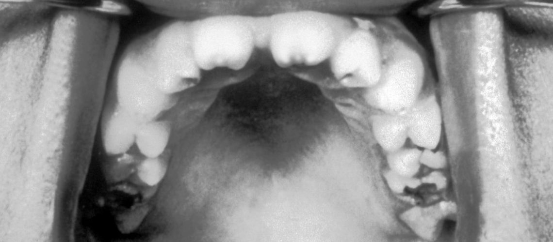 Hutchinson_teeth_congenital_syphilis_PHIL_2385.rsh_-1152x759.jpg