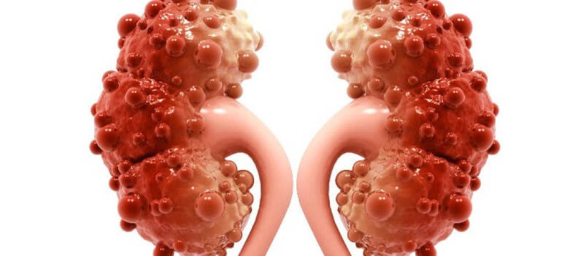 Renal-Cysts-1.jpeg