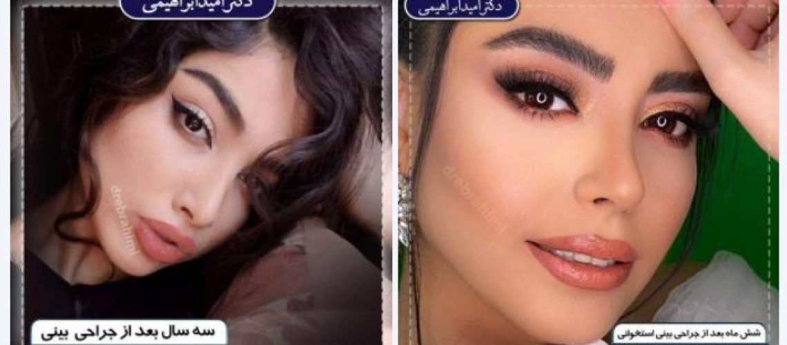 راز موفقیت در جراحی بینی استخوانی ؛ انتخاب جراح مناسب مهم‌تر از هر چیز است