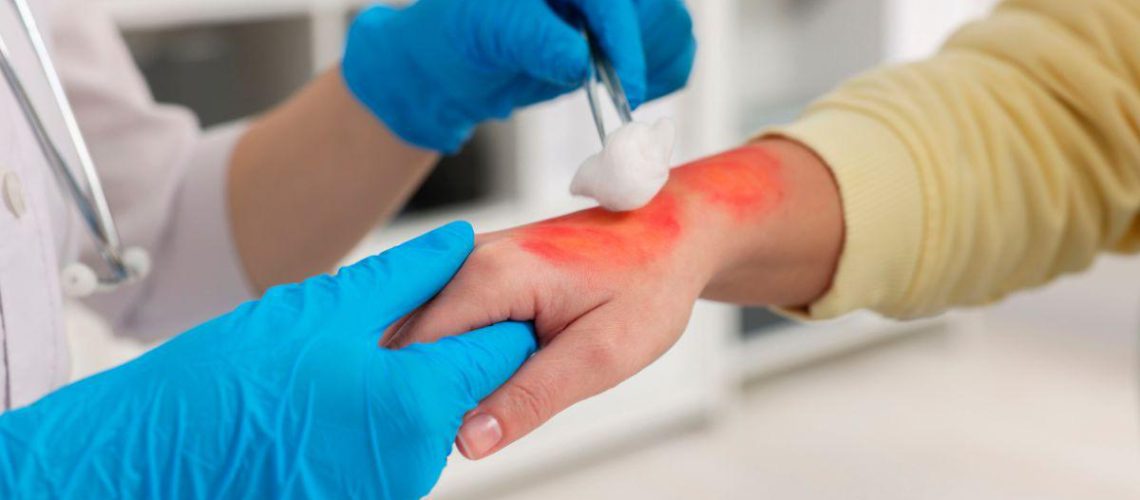زخمهای سوختگی و کارهایی که نباید انجام داد