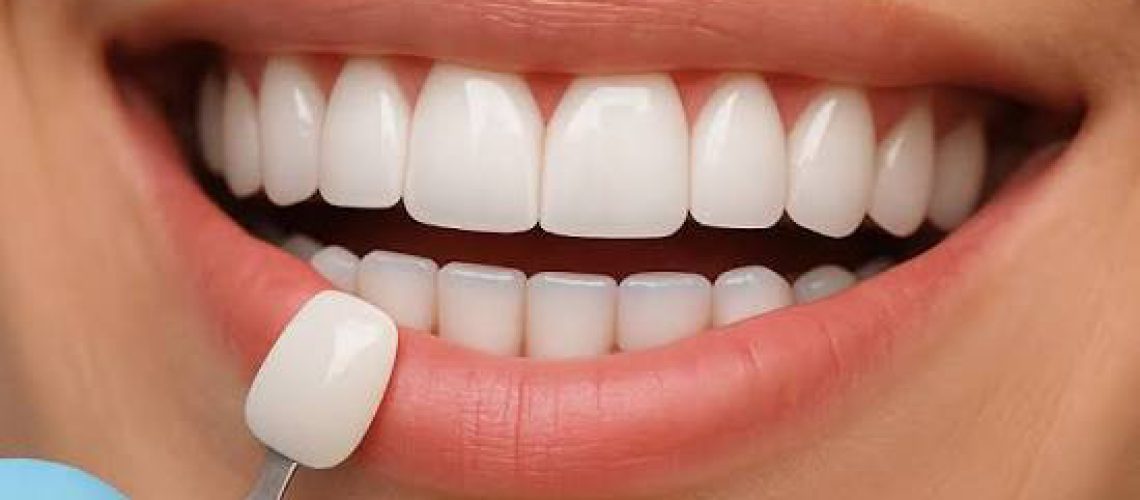 قیمت لمینت دندان
