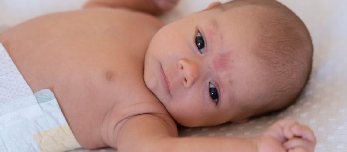newborn-neck-rashes-treatment-main.jpg