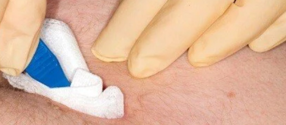 نحوه پانسمان بعد از جراحی کیست مویی در شفا کلینیک